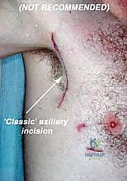 إجراء الشق الجراحي الأولي