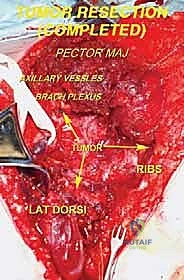 ورم حميد ضاغط على الأعصاب