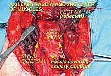 توضيح تشريحي لمنطقة الإبط المعقدة