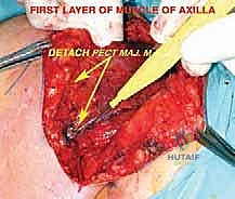 تحديد نوع الورم وموقعه