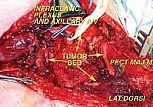 ورم خبيث متشعب في الإبط