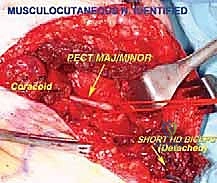 الهياكل العصبية والدموية في الإبط