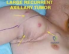 استئصال أورام الإبط المعقدة: دليل شامل للمرضى مع الأستاذ الدكتور محمد هطيف