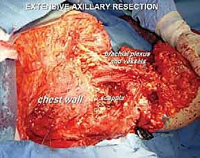 جلسات العلاج الطبيعي لاستعادة حركة الذراع