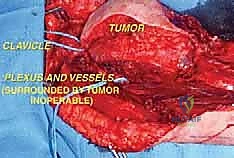 صورة توضيحية لـ استئصال أورام الإبط المعقدة: دليل شامل للمرضى مع الأستاذ الدكتور محمد هطيف