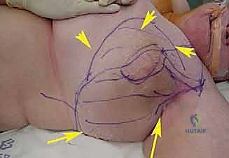 صورة لورم عصبي معقد تم استئصاله بنجاح