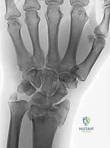 توضيح لكسر الكعبرة البعيد وتقنية الصفيحة الجسرية