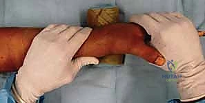 تحضير المريض وتعقيم الذراع قبل الجراحة