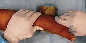 إدخال الصفيحة تحت الجلد