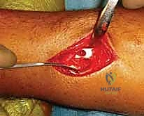 الأشعة السينية تظهر التفتت الشديد في العظم