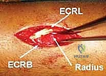 إغلاق الجروح الجراحية الدقيقة
