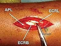 الأشعة تظهر التئام العظم بشكل ممتاز بعد فترة من الجراحة