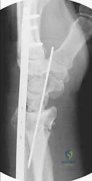 Bridge Plating for High-Energy Distal Radius Fractures: An Intraoperative Masterclass