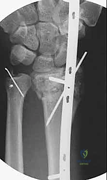 Intraoperative Surgical Step