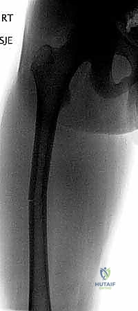 كسور عظم الفخذ عند الأطفال: دليل شامل للتثبيت بالمسامير المرنة مع الأستاذ الدكتور محمد هطيف في صنعاء