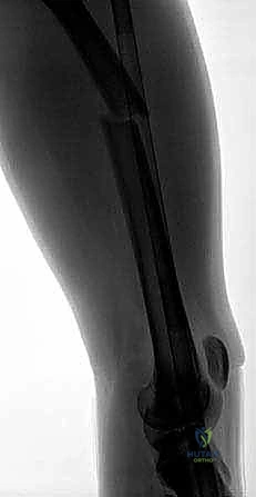 التشريح الدقيق لكسور عظم الفخذ عند الأطفال