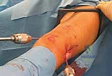 خطوات عملية التثبيت بالمسامير المرنة - الجزء الأول