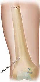 فوائد التثبيت بالمسامير المرنة