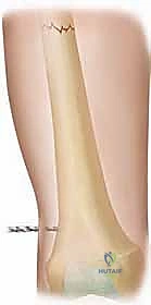 تطور طرق علاج كسور الفخذ عبر الزمن