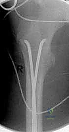 صورة توضيحية لـ كسور عظم الفخذ عند الأطفال: دليل شامل للتثبيت بالمسامير المرنة مع الأستاذ الدكتور محمد هطيف في صنعاء