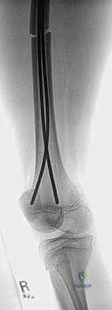 Pediatric Femoral Shaft Fractures: Masterclass in Flexible Intramedullary Nailing