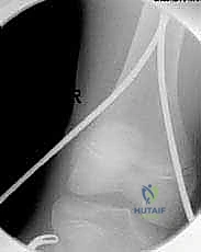 صورة توضيحية لـ كسور عظم الفخذ عند الأطفال: دليل شامل للتثبيت بالمسامير المرنة مع الأستاذ الدكتور محمد هطيف في صنعاء