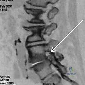 تشخيص تضيق القناة الشوكية بالأشعة