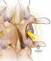Illustration of spinal canal stenosis - Dr. Mohammed Hutaif