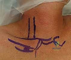 جراحة مفصل القص الترقوي: استئصال الترقوة وإعادة البناء - دليل شامل للمرضى مع الأستاذ الدكتور محمد هطيف