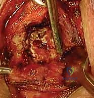 عدم استقرار مفصل القص الترقوي