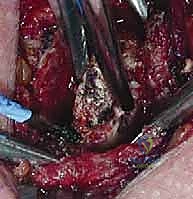 استخدام الرنين المغناطيسي لتقييم الأربطة