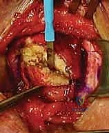 الهياكل الحيوية خلف المفصل القصي الترقوي