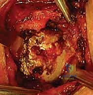 إعادة بناء المفصل باستخدام الطعم الوتري