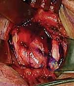 كشف المفصل وحماية الأنسجة الحيوية