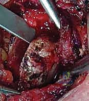 الشق الجراحي الدقيق فوق المفصل