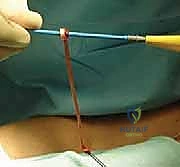 صورة توضيحية لـ جراحة مفصل القص الترقوي: استئصال الترقوة وإعادة البناء - دليل شامل للمرضى مع الأستاذ الدكتور محمد هطيف