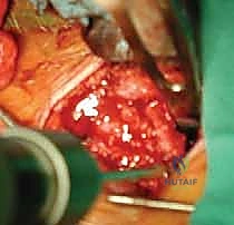 التآكل والخشونة في المفصل