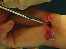 استخدام أحدث التقنيات الجراحية 4K في العمليات