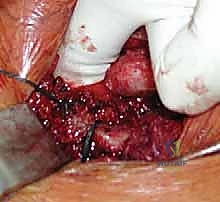 صورة توضيحية لـ جراحة مفصل القص الترقوي: استئصال الترقوة