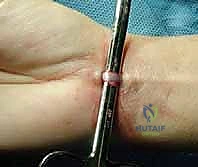 صورة توضيحية لـ جراحة مفصل القص الترقوي: استئصال الترقوة وإعادة البناء - دليل شامل للمرضى مع الأستاذ الدكتور محمد هطيف