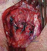 صورة توضيحية لـ جراحة مفصل القص الترقوي: استئصال الترقوة وإعادة البناء - دليل شامل للمرضى مع الأستاذ الدكتور محمد هطيف