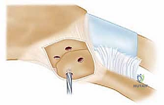 الخيارات العلاجية التحفظية