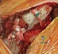 Illustration of medial clavicle excision - Dr. Mohammed Hutaif