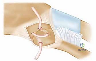 الأشعة المقطعية لتشخيص خلع المفصل