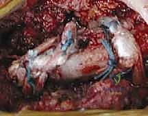 الدكتور محمد هطيف أثناء إجراء الجراحة الميكروسكوبية