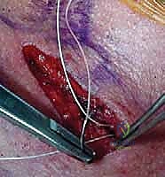 صورة توضيحية لـ جراحة مفصل القص الترقوي: استئصال الترقوة وإعادة البناء - دليل شامل للمرضى مع الأستاذ الدكتور محمد هطيف