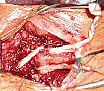 استئصال الجزء الداخلي من الترقوة