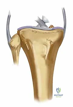 صورة توضيحية لـ كسور الهضبة الظنبوبية ثنائية اللقمة: دليل شامل للعلاج والتعافي مع الأستاذ الدكتور محمد هطيف