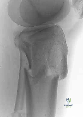 صورة توضيحية لـ كسور الهضبة الظنبوبية ثنائية اللقمة: دليل شامل للعلاج والتعافي مع الأستاذ الدكتور محمد هطيف