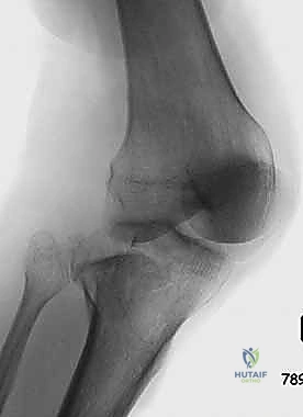 التشريح المفصلي للركبة والهضبة الظنبوبية